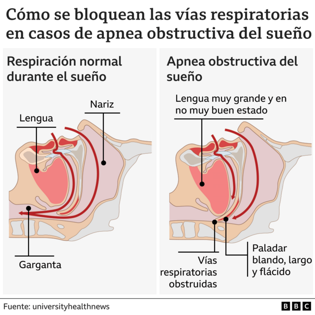 Gráfico que ilustra la respiración normal y la apnea del sueño.