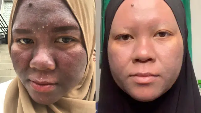 Wajah Nur Tya setelah memakai kosmetik diduga mengandung merkuri