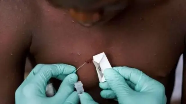 मंकीपॉक्स