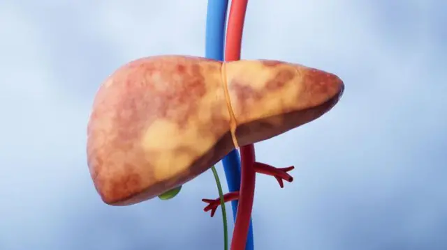 ਫੈਟੀ ਲੀਵਰ