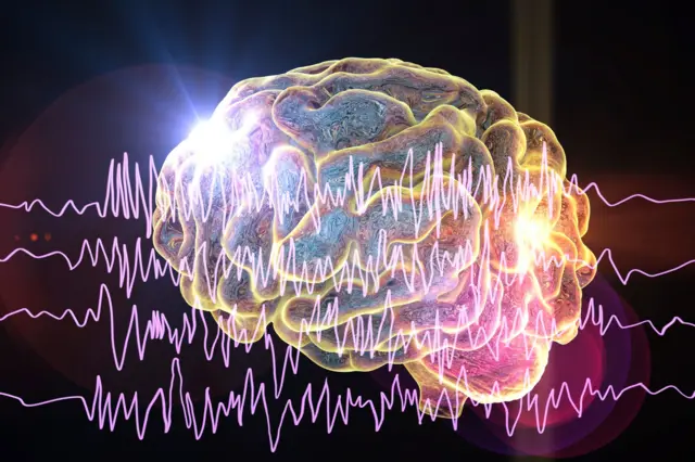 Ilustración de un cerebro con epilepsia