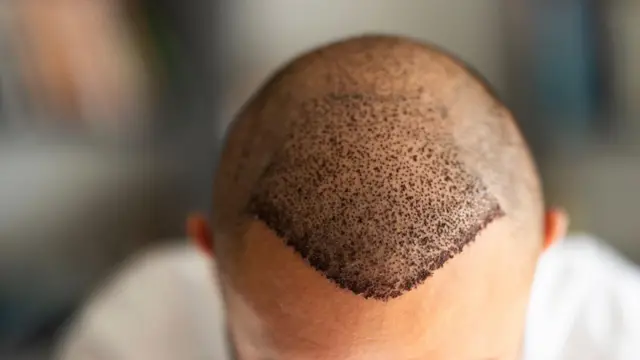 Aworan ori ọkunrin kan lẹyin to ṣiṣẹ abẹ irun tan.