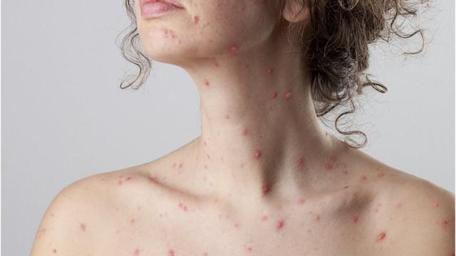 Mulher com sarampo no colo e pescoço