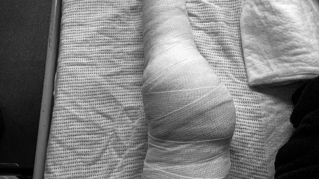 नेक्रोटाइजिङ्ग फ्यासिआइटिस