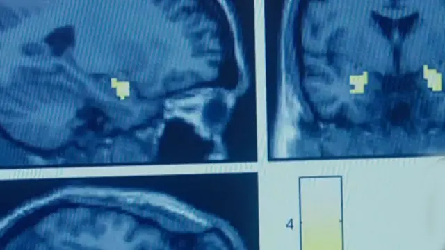 La amígdala reaccionando a imágenes que causan miedo.