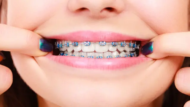 Dientes con ortodoncia