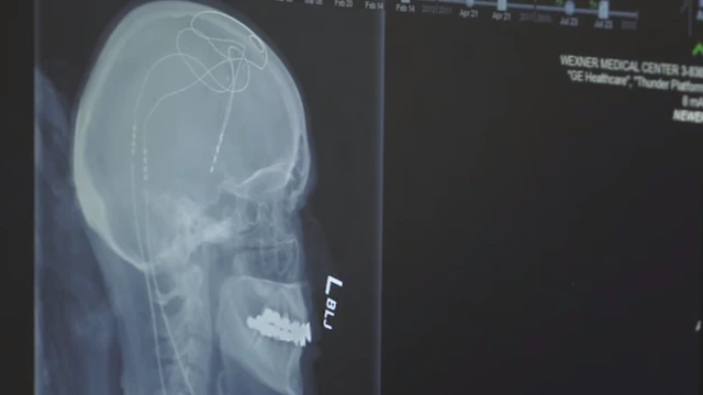 مسح بالأشعة يظهر الأسلاك المزروعة في المخ