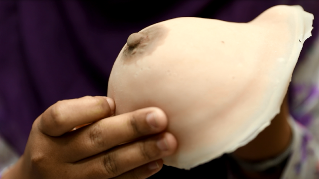 A breast prosthesis