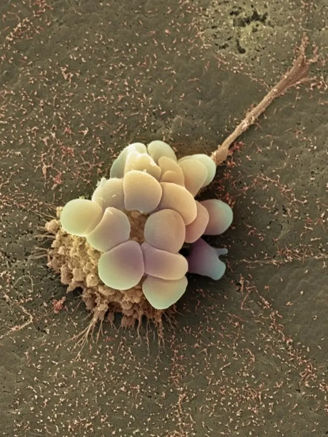 سرطان تخمدان