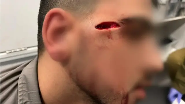 شرطي إسرائيلي جريح بعد أن أصيب بطعنة في وجهه