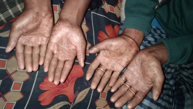 অমল সরকার এবং অপু সরকারের হাত