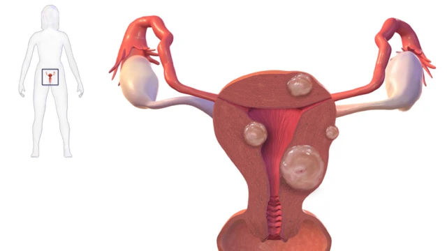 Uterine Fibriod