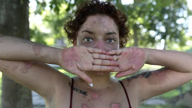 Onye na-arịa ọrịa "Lupus"