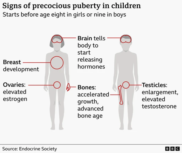 A graphic illustration of a male and female body labels the signs of precocious puberty in children.