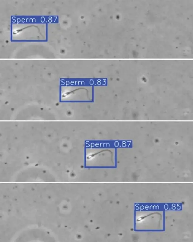 Знайти одну клітину в зразку при азооспермії майже неможливо. Але система робить це за лічені секунди