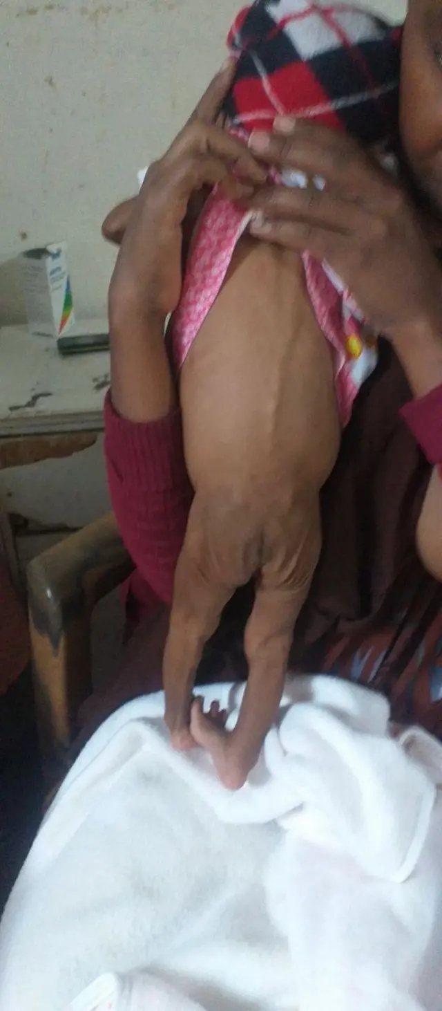 ብሕጽረት ምግቢ ዝተጠቕዐ ህጻን