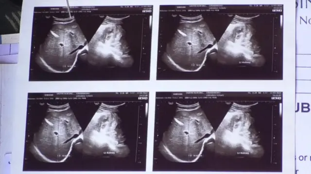 కిడ్నీ వ్యాధి ఎక్స్‌రే