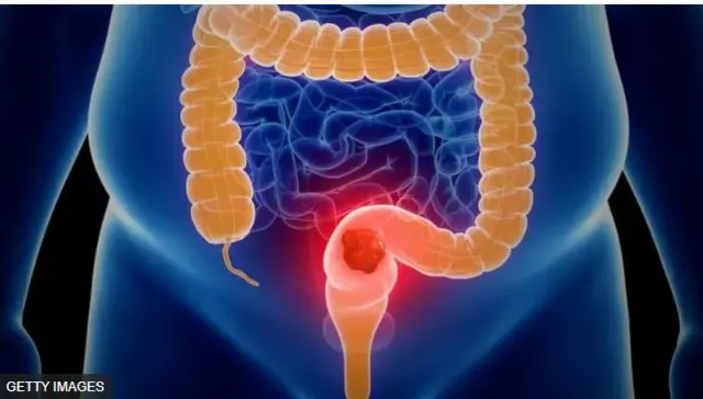 Àwòrán ẹ̀yà ara ikùn 