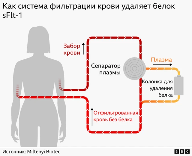 Схема очищения крови от белка sFlt-1. Кровь проходит через сепаратор плазмы и колонку, где удаляется белок, и после этого переливается женщине обратно.