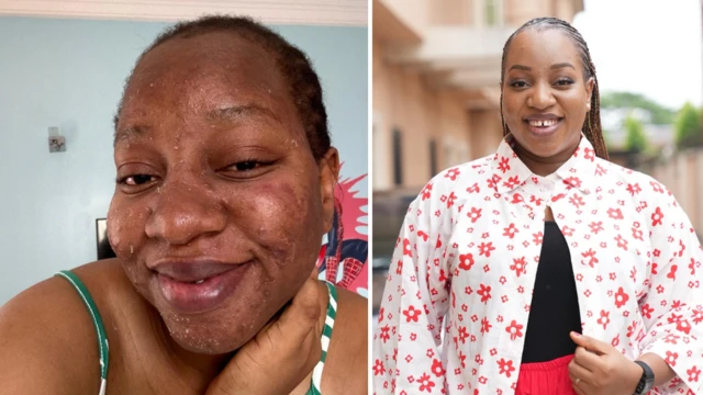 Chiamaka Okudoh battling acne for her face