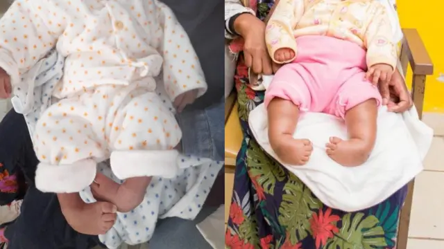 የእግር መቆልመም መምጫው መንስዔው አይታወቅም