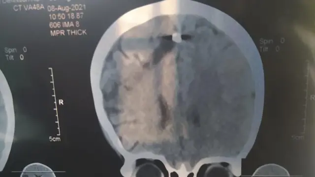 လက်နက်ကြီးကျည်စရှိနေတဲ့ ခေါင်းအလယ်တည့်တည့်နေရာကို မြင်နေရတဲ့ဓာတ်မှန်