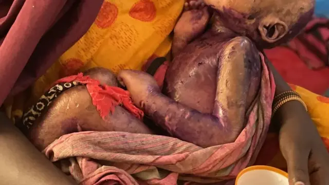 சோமாலியா குழந்தை