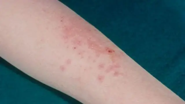 ایگزیما کی مختلف علامات ہے جن میں جلد کا خشک ہونا، پھٹنا، رنگ بدلنا، خارش ہونا وغیرہ شامل ہیں