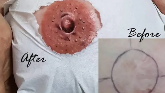 خالکوبی دینا مدو برای پوشاندن جای زخم‌های ناشی از جراحی برداشتن سینه برای یک بیمار سرطانی طراحی شده بود.