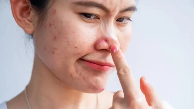 Welwelka wuxuu kiciyaa qanjidhada maqaarka oo soo saara walax dufan leh oo loo yaqaanno sebum, taas oo xiri karta daloollada kana qayb qaadan karta finanka.