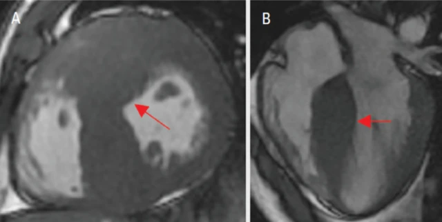 Duas imagens de ressonância magnética cardíaca comparando um coração saudável de atleta com um coração com miocardiopatia hipertrófica, mostrando a parede muscular do ventrículo esquerdo visivelmente mais espessa no primeiro caso.