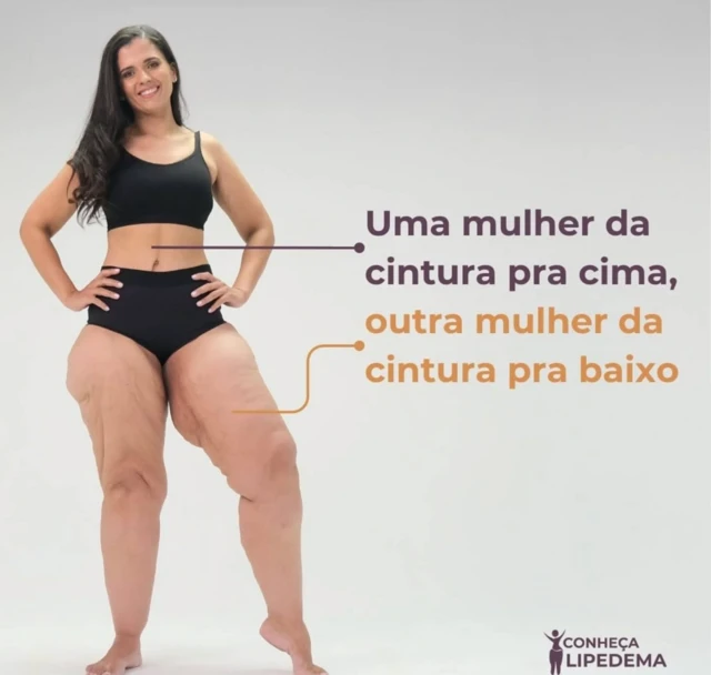 Paciente mostra a diferença causada pelo lipedema no formato de seu corpo em foto de campanha de conscientização da doença feita pela ONG Movimento Lipedema