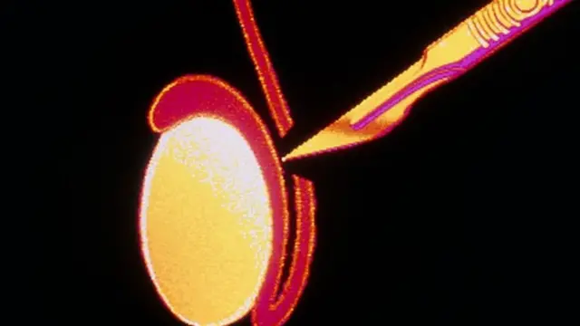 Ukataji wa mshipa wa kupitishia mbegu ya kiume ya uzazi, huwa ni tendo la kudumu, licha ya kuwepo kwa wanaume ambao hufanyiwa operesheni ya kurejesha tena hali hiyo