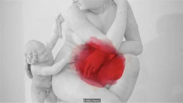 ਐਂਡੋਮੇਟ੍ਰਿਓਸਿਸ