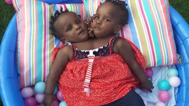 అవిభక్త కవలలు