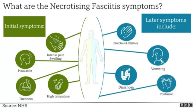 Aworan bi aisan Vibrio vulnificus ṣe n ran ni ara 
