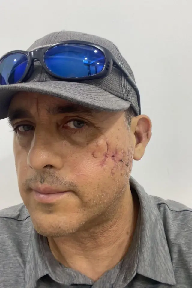 Mauricio mostra a cicatriz deixada no rosto após seu encontro com o tubarão-das-galápagos