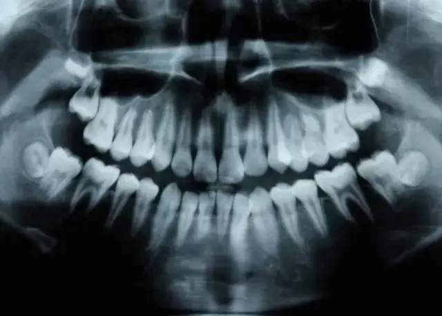 Radiographie d'une dentition