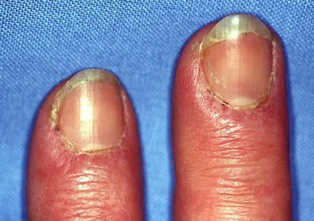 ડર્મેટોમાયોસાઇટિસમાં નખની આસપાસ સોજો આવી શકે છે