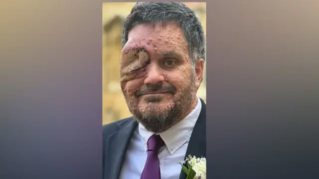 Oliver Bromley a déclaré que les médecins lui avaient retiré l'œil droit il y a deux ans