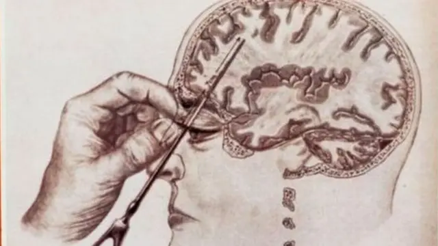 लोबोटॉमी