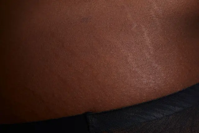 Vue en plein écran d'une peau humaine présentant des vergetures