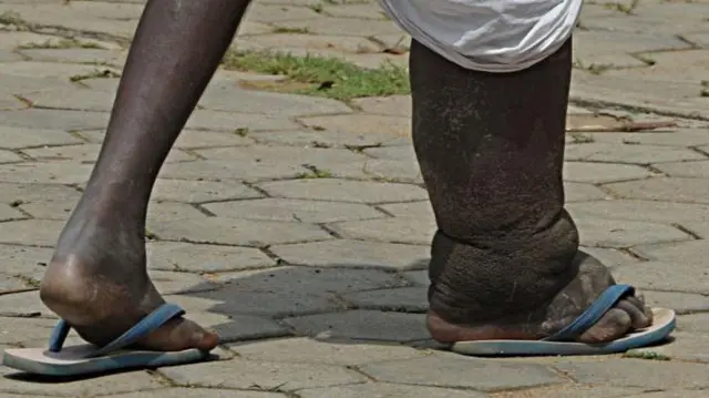 Onye nwere ọrịa ụkwụ aba 'shoe'