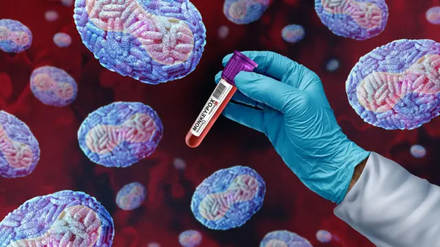 குரங்கம்மை அறிகுறிகள், பரவும் வழிகள்