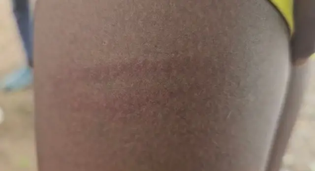 மாணவரின் உடலில் உள்ள தழும்பு