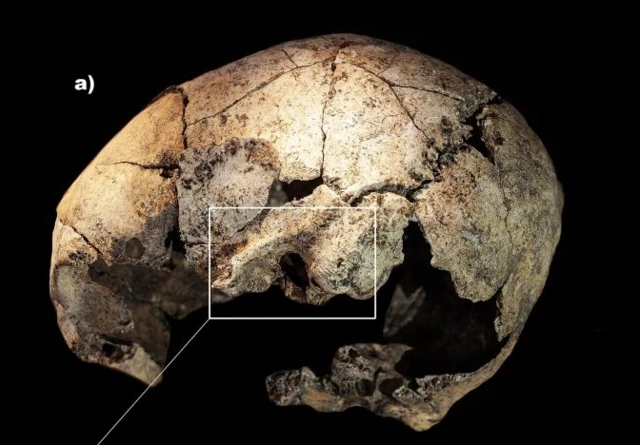 ร่องรอยการกรีดและเจาะกะโหลกศีรษะหลังใบหู เพื่อรักษาโรคหูชั้นกลางอักเสบ