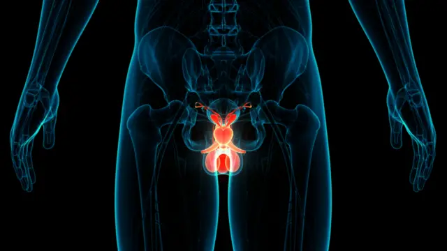 प्रोस्टेट कॅन्सर