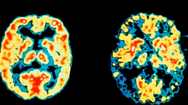 Недостаток сна может способствовать развитию таких заболеваний, как болезнь Альцгеймера