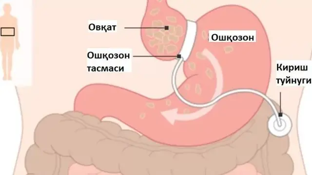 Ошқозонни тугиш амалиёти