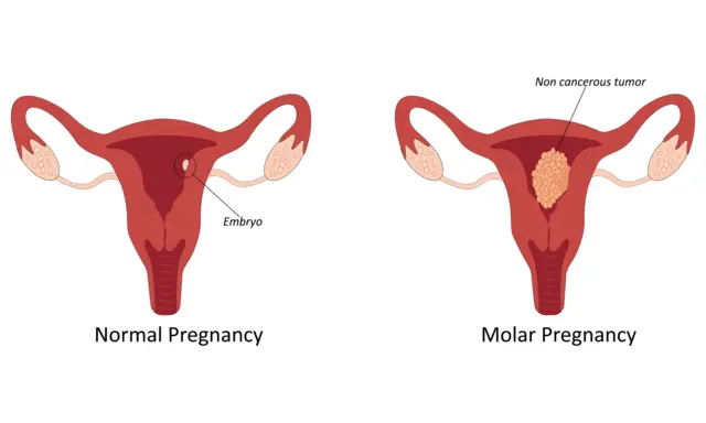 मोलार प्रेगनन्सी म्हणजे काय?